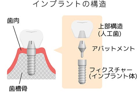 インプラントの構造