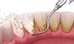 歯石やプラーク（歯垢）を取り除